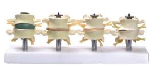 desgaste das vertebras
